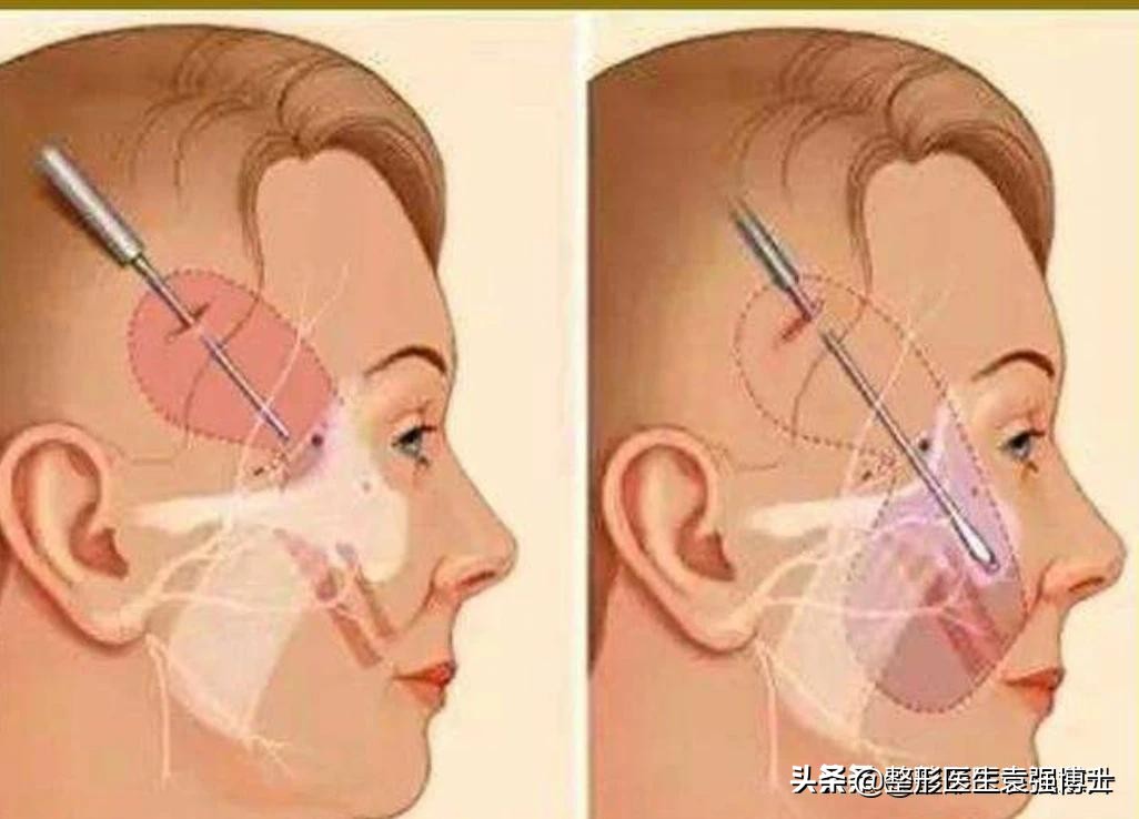 小拉皮15天能恢复自然么,小拉皮恢复的真实感受案例