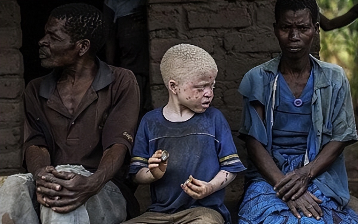 非洲最特殊的人群：血液堪比黄金，遗骸卖上百万，却无法健康成长