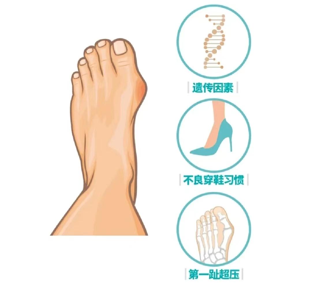 拇外翻会引起脚趾疼吗女性,为什么女人脚拇外翻的比较多