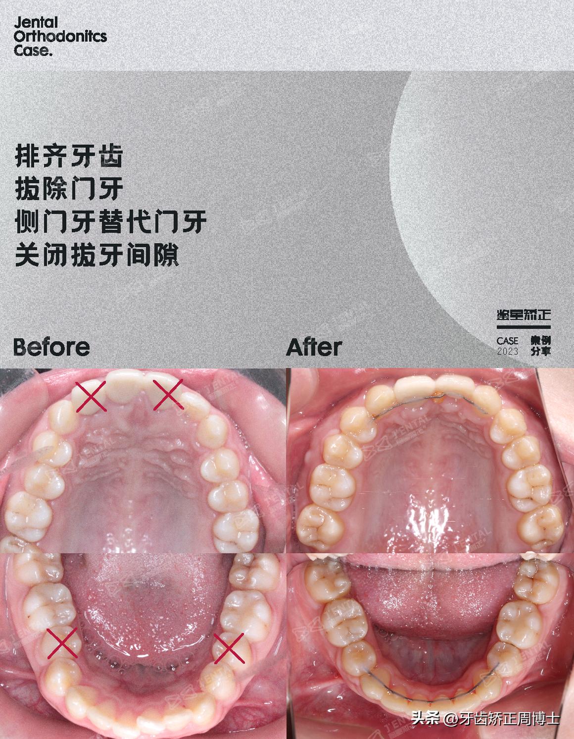 骨性上颌前凸嘴怎么矫正,厚嘴唇与嘴凸有关吗