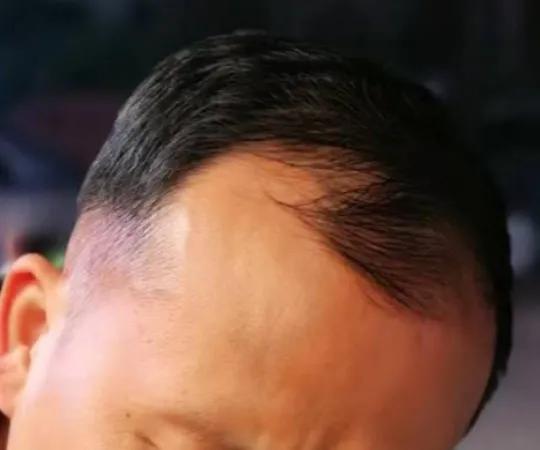 植发的亲身经历和感受,植发1000毛囊真实经历视频