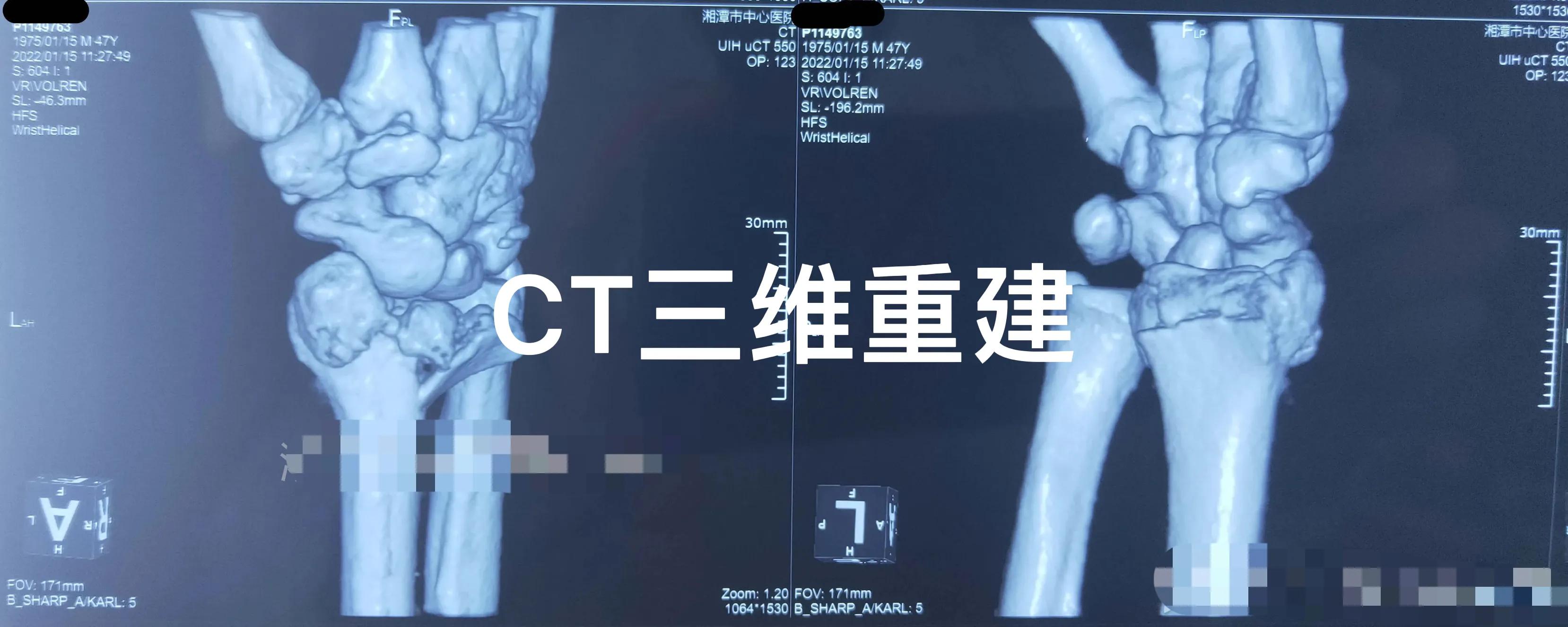 老年人腕部骨折手法复位石膏固定治疗方法指导