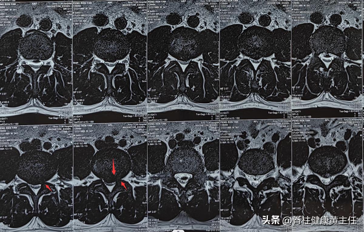 腰椎盘突出臀骨与大腿连接处疼痛,腰间盘突出臀部疼痛脚麻怎么治疗