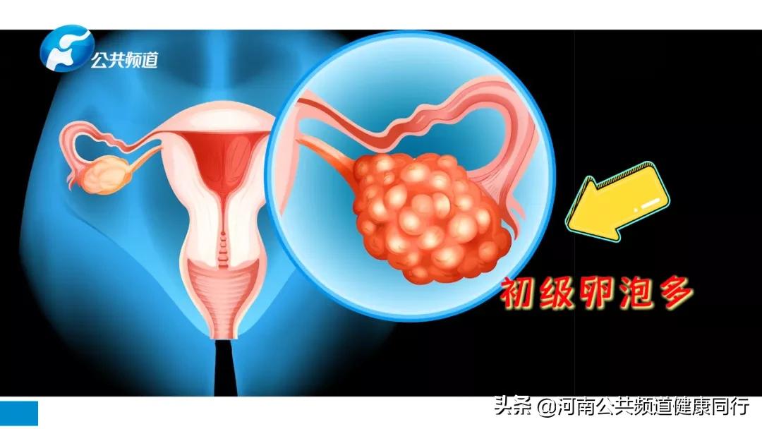 警惕这些症状！可能是多囊卵巢综合征——河南中医药大学第一附属医院内分泌科主任医师张跃红教授