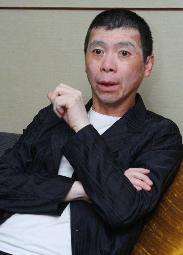 白癜风冯小刚症状,冯小刚谈不治白癜风的原因