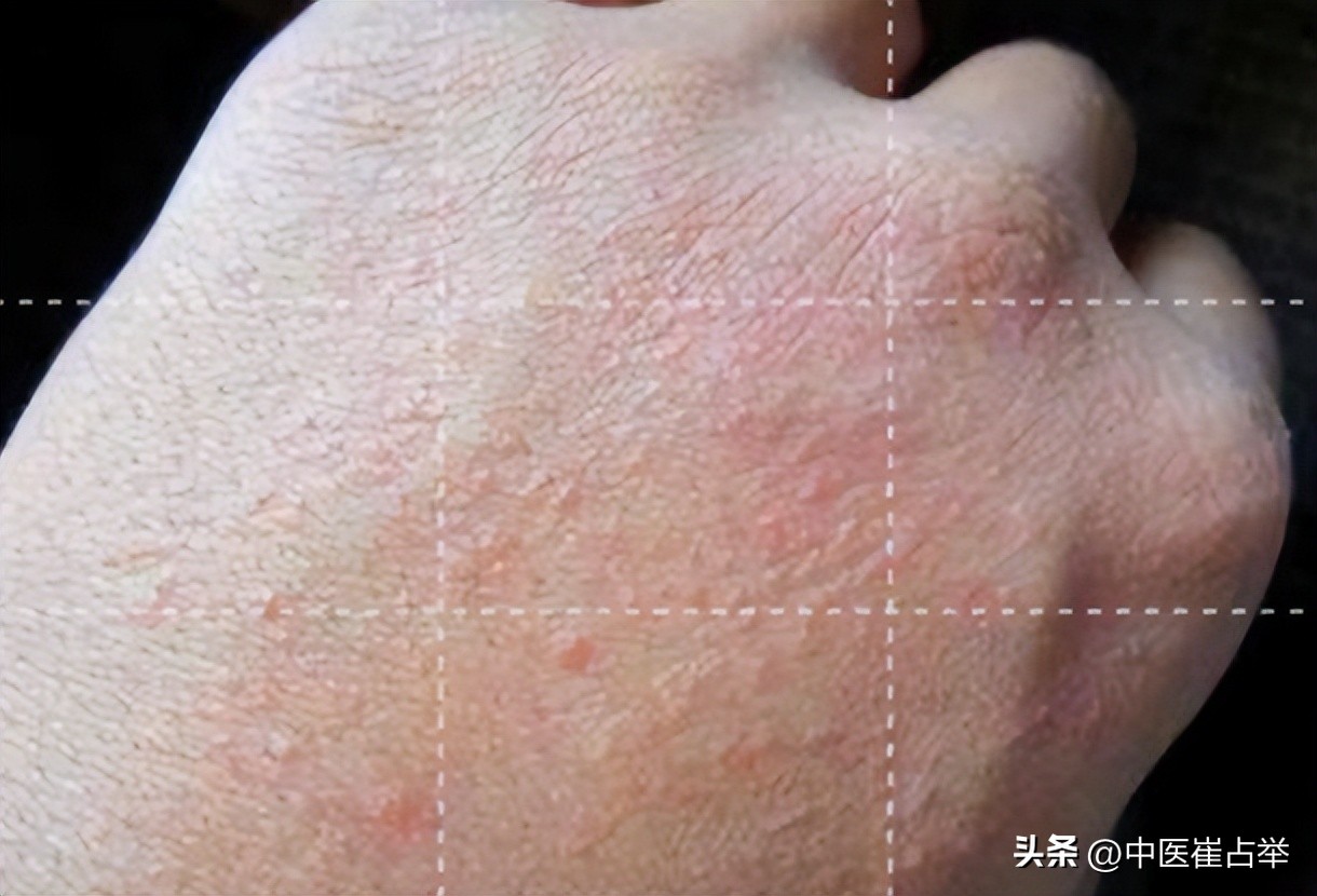 湿热齿痕吃什么中成药能祛湿热,健脾祛湿清肝胆湿热的中成药