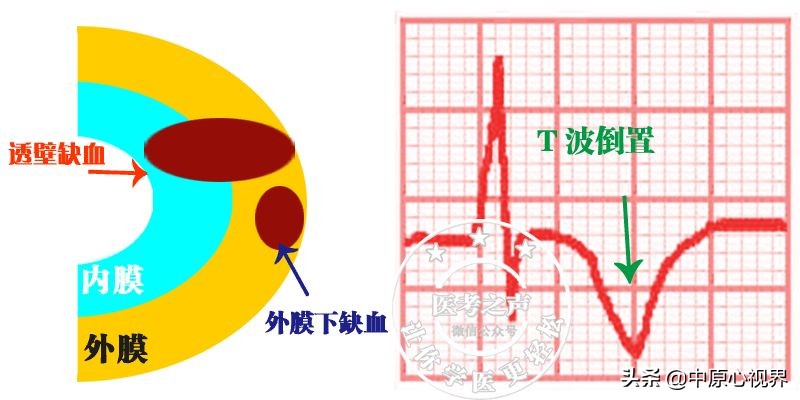护考几种常见的心电图,常见的心电图图形分析