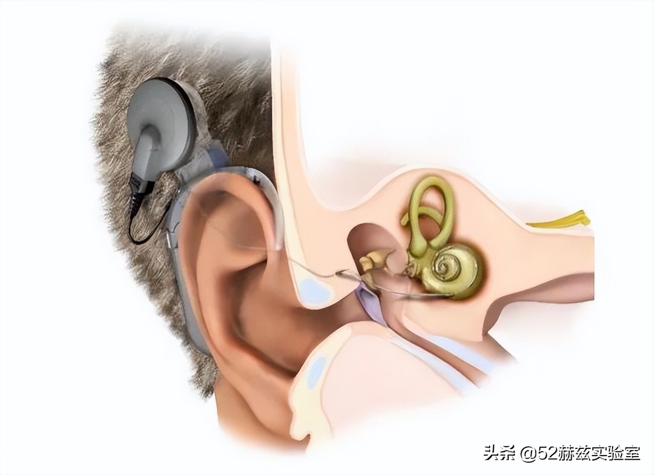 国产人工耳蜗怎么样,进口人工耳蜗价格表