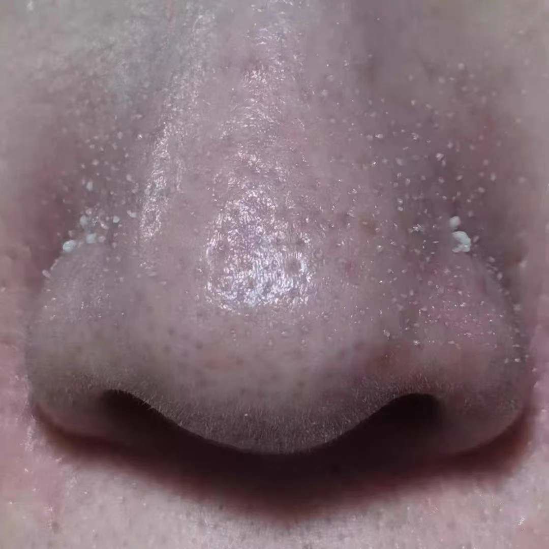 眉心鼻翼和下巴长粉刺为什么,鼻头上起粉刺什么原因引起的图片