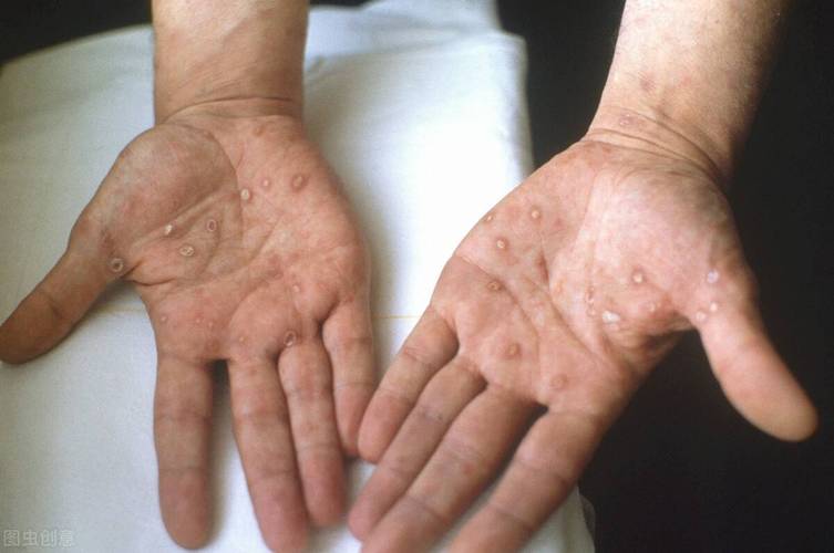 梅毒是因为脚气导致的吗,梅毒脚气怎么治疗