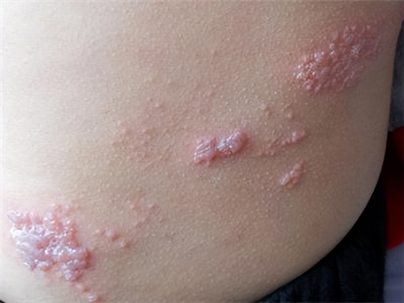 带状疱疹又叫“缠腰蛇”，该怎么治？医生：这10类人易被盯上！