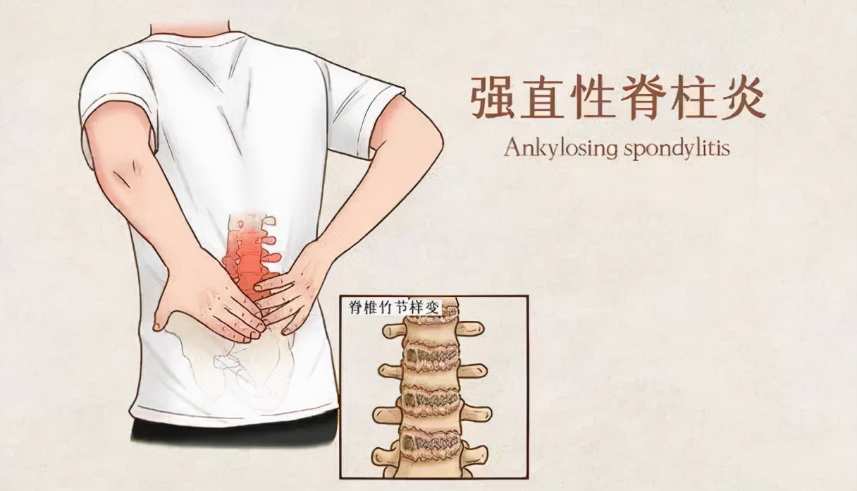 强直性脊柱炎中医可以治好吗,强直性脊柱炎稳定期中医辨证论治