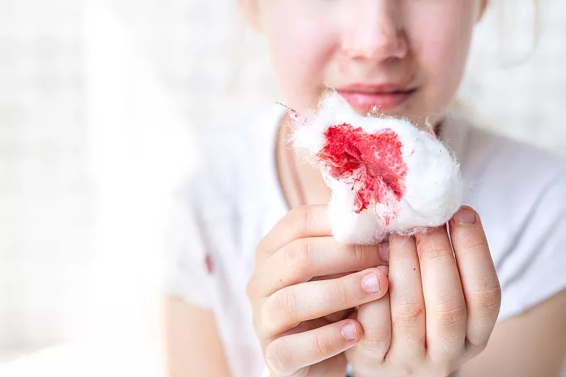 孩子流鼻血怎么快速止血,流鼻血别仰头一招让你快速止血