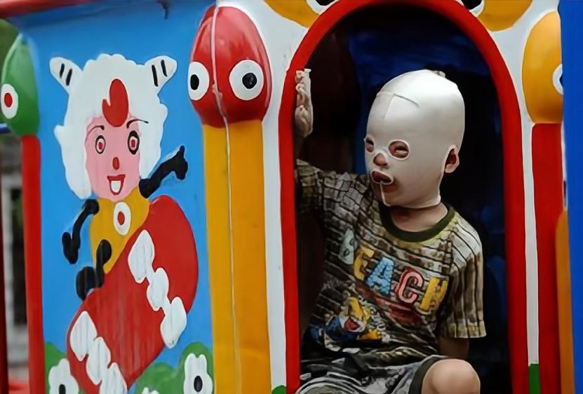 小孩子脸被火烧伤戴着面具,因烧伤带面具的山西小男孩