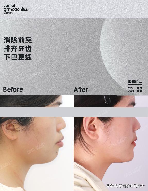 闭嘴巴下巴有核桃纹做什么手术,为什么下巴会有像核桃一样的纹路