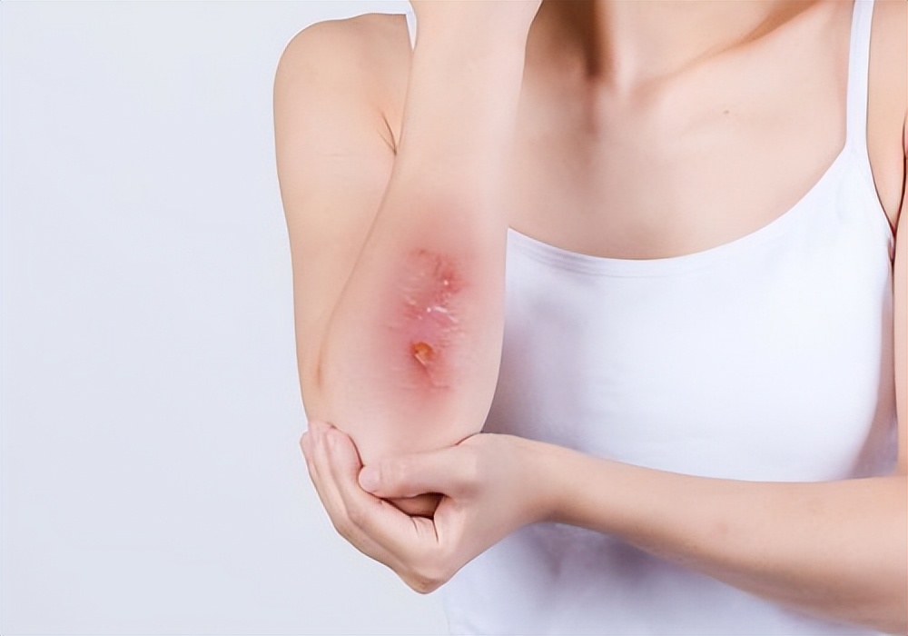 红霉素软膏淡斑真的有效吗,2块钱的红霉素软膏能祛斑吗