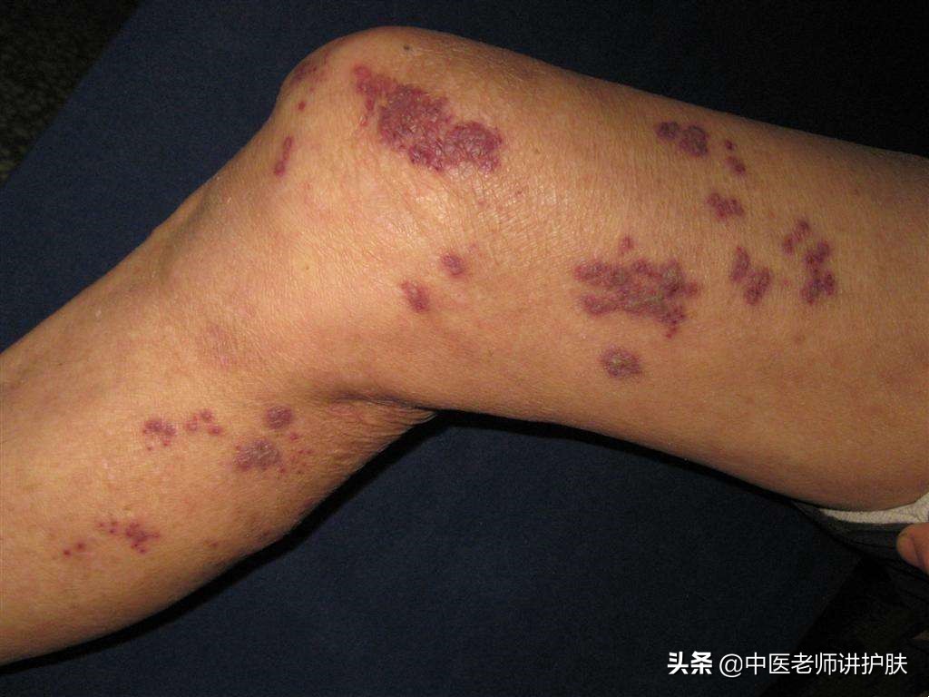 带状疱疹疼痛难忍有什么特殊药物,疼痛带状疱疹