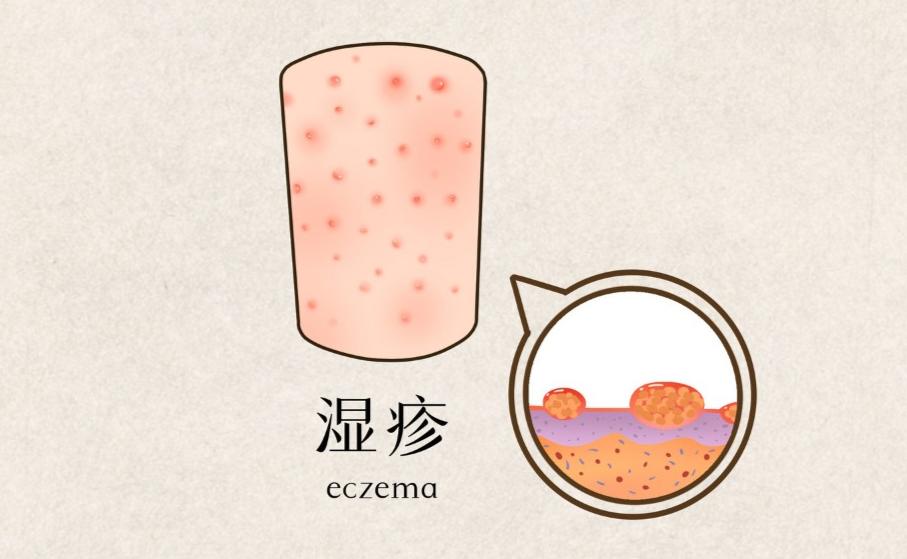 湿疹症状有哪些？湿疹原因、预防一次看，4招有效止痒