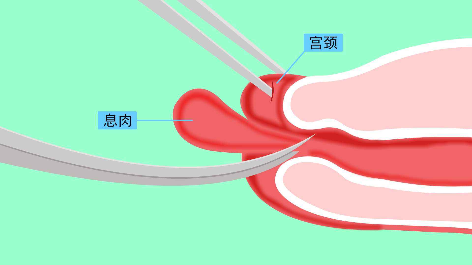 带血丝的褐色分泌物是怎么回事,有血丝和褐色分泌物是什么情况