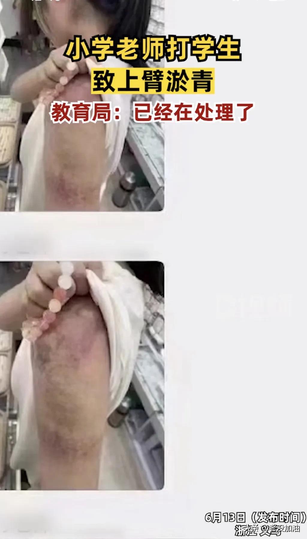 孩子被打伤了老师隐瞒事实,家长看到孩子被老师打伤了