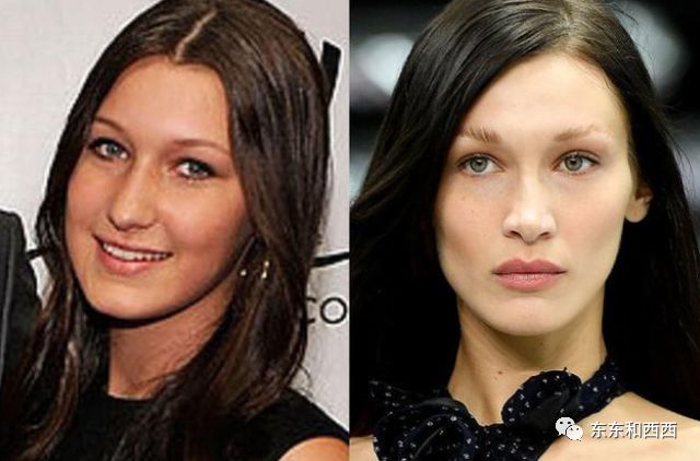 给女儿整鼻子,给两个女儿整鼻子