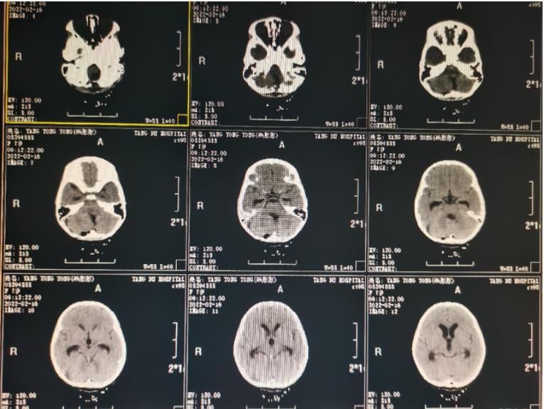 第四脑室室管膜瘤手术怎么做,第三脑室管膜瘤治疗方法