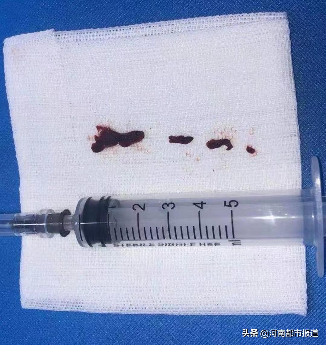 听说过心梗脑梗吗,心梗和脑梗的几大信号