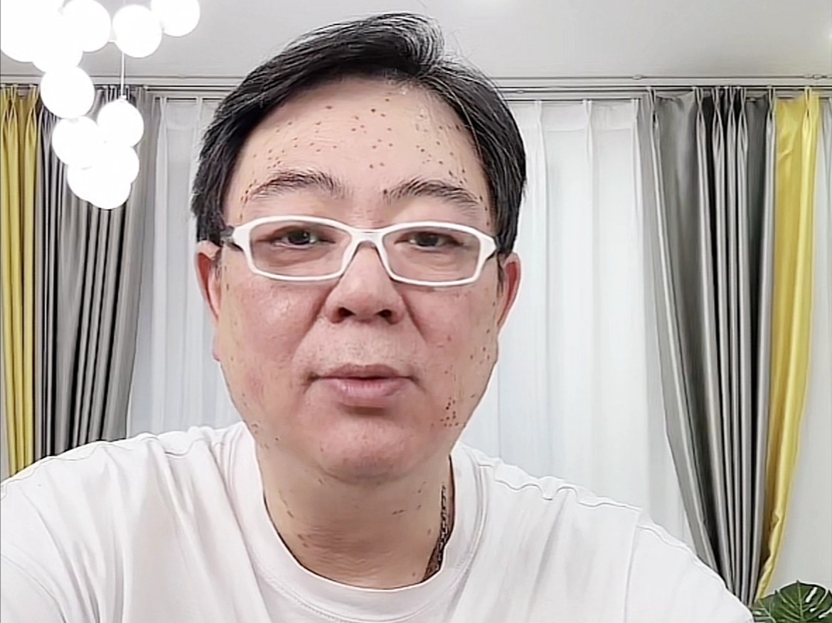 高亚麟是不是得了什么怪病,高亚麟扁平疣怎么祛除的