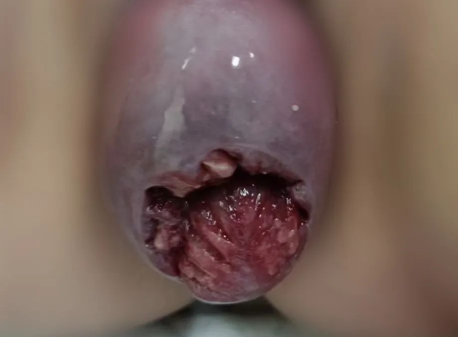 【科普】孕妈子宫“掉”到阴道口!备孕二胎,这件事一定要做