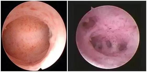 什么是宫腔镜？宫腔镜可以治疗哪些疾病？