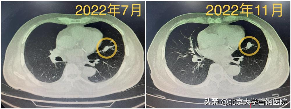 医生自述：拥抱微创时代，八旬老人肺癌术后康复出院