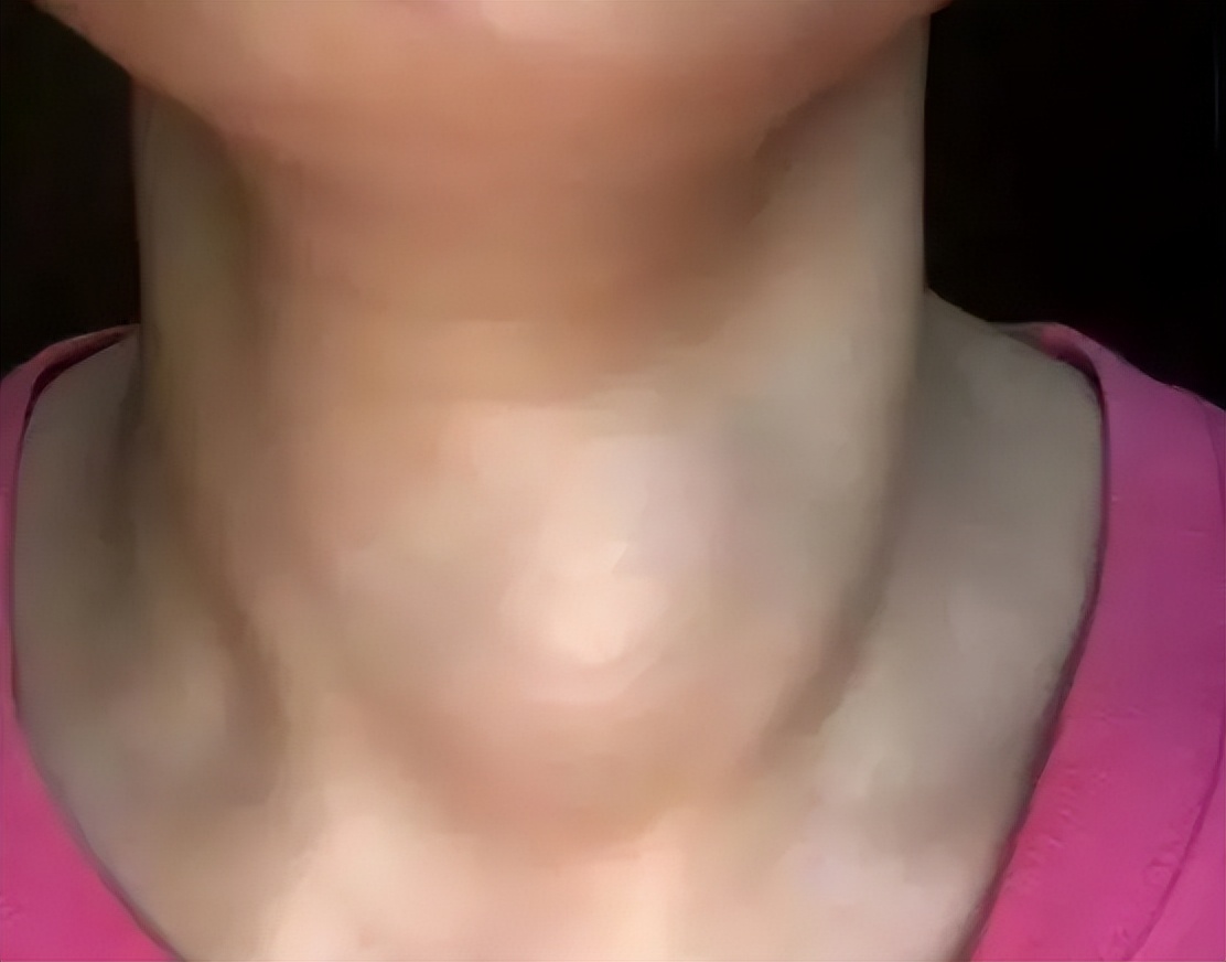 儿童患有甲状腺结节怎么办,北京治疗甲状腺结节最好中医医院