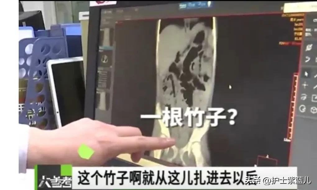 老人不慎从楼梯上重重摔下,老人意外从楼上摔下来