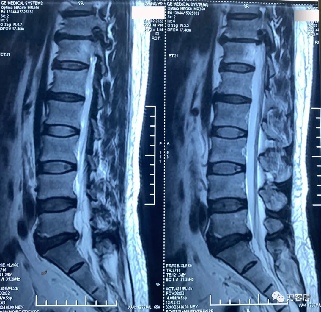 良性单侧下肢肌萎缩,下肢肌肉萎缩24年能治好吗