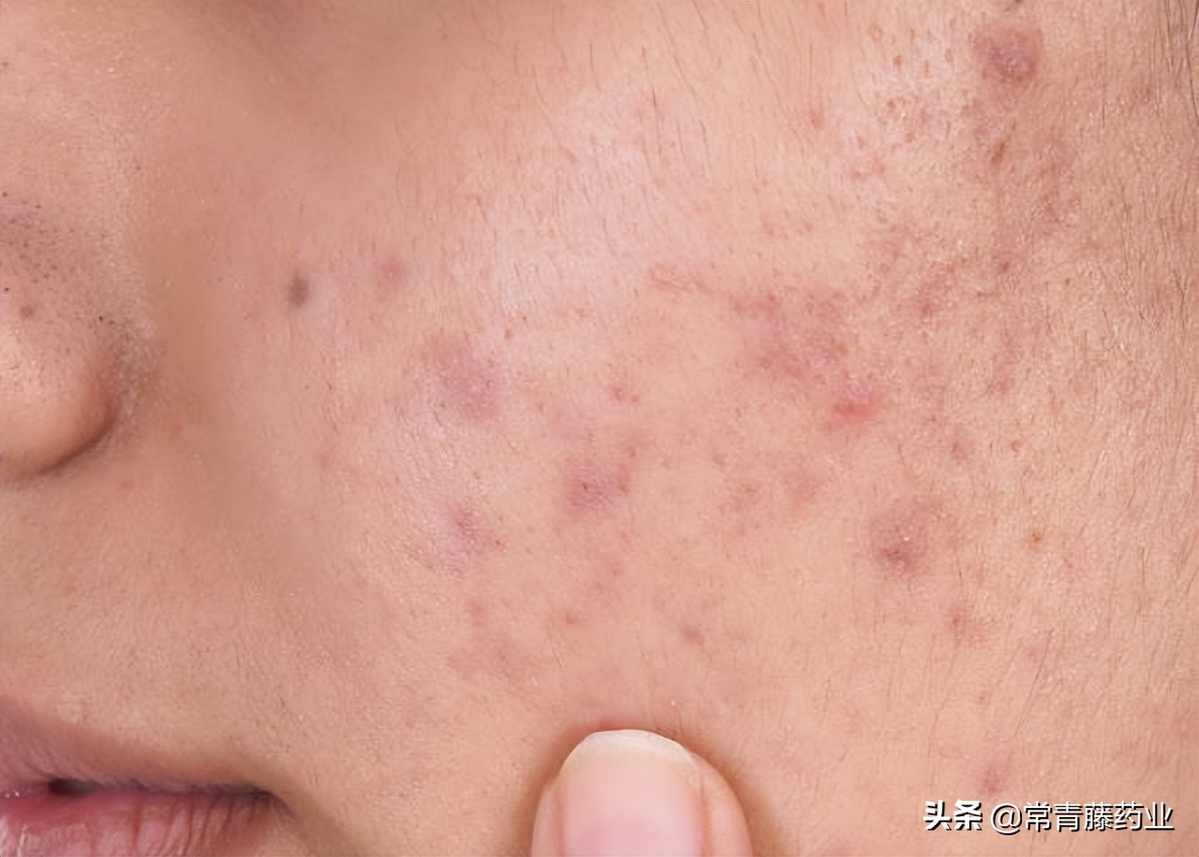 红痘印黑痘印如何快速解决,留下一大片黑红痘印怎么办