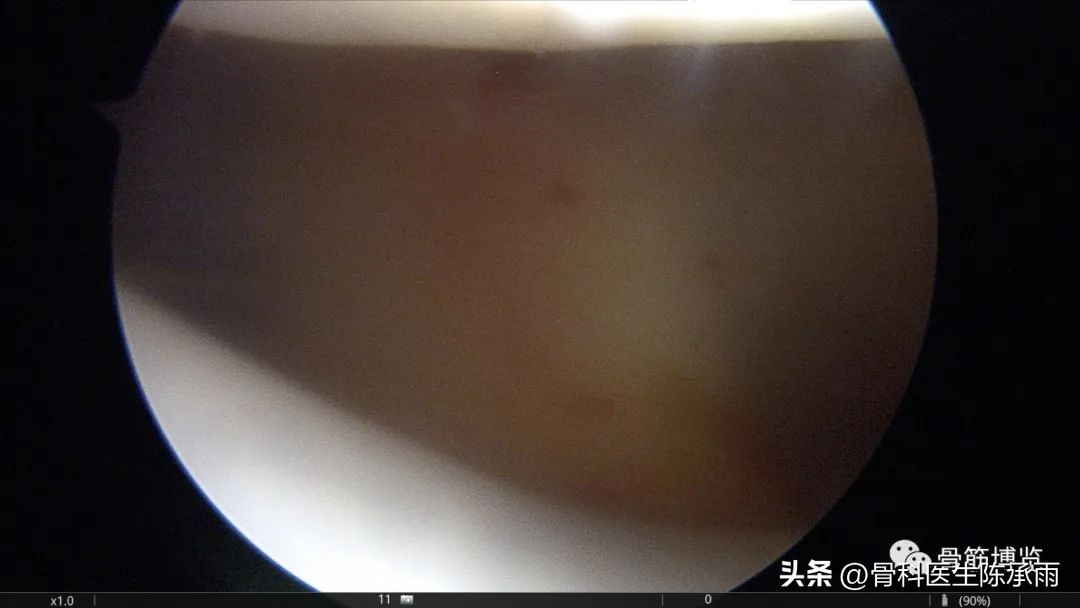 髌骨脱位保守康复训练具体步骤,髌骨脱位重建手术全过程