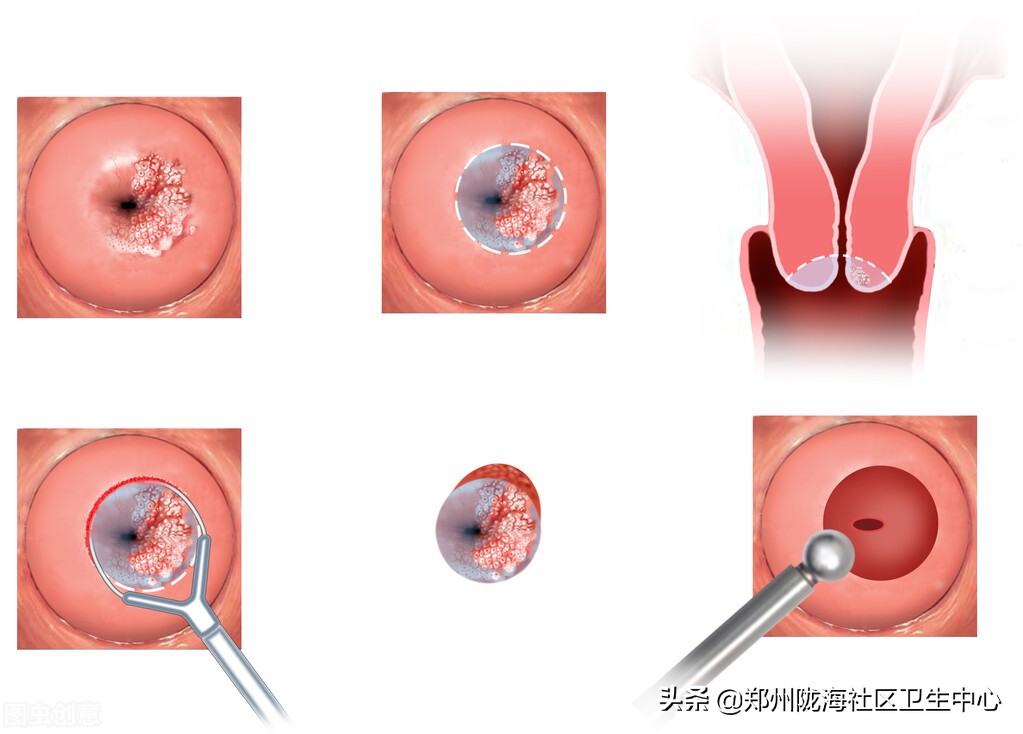 宫颈筛查报告怎么看,宫颈筛查的报告单怎么看
