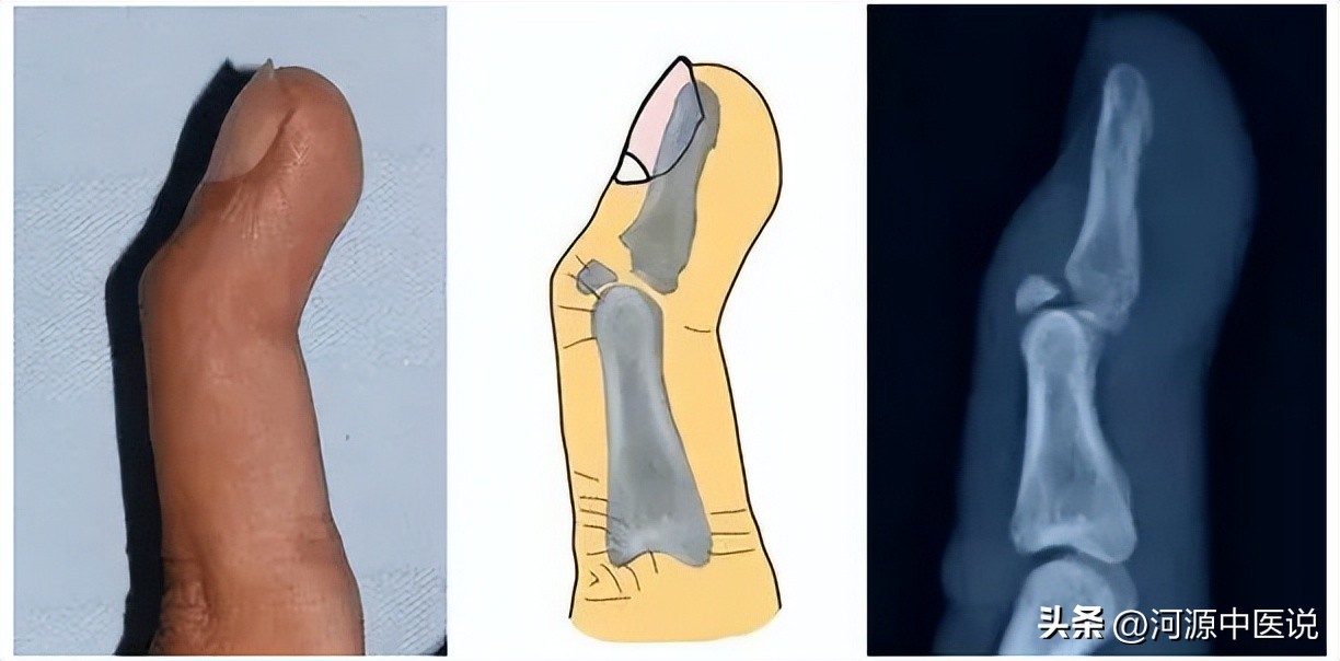 打篮球戳到手指后的治疗方法,打篮球戳到手肿胀怎么回复