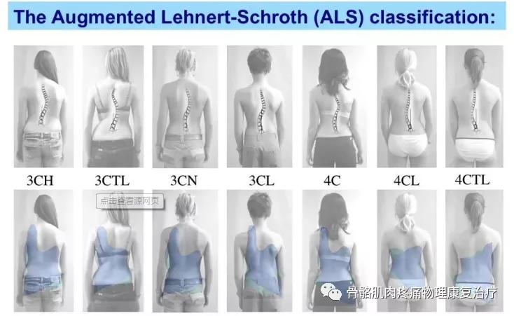脊柱侧弯23度施罗斯矫正有用吗,非结构性脊柱侧弯