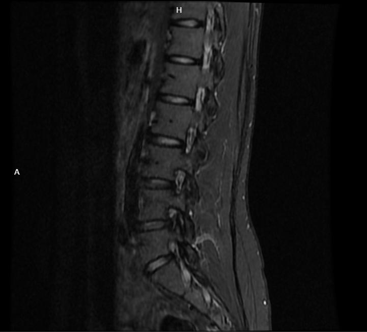 腰椎间盘突出腰部麻木疼痛,腰椎间盘突出下肢酸胀左脚发麻