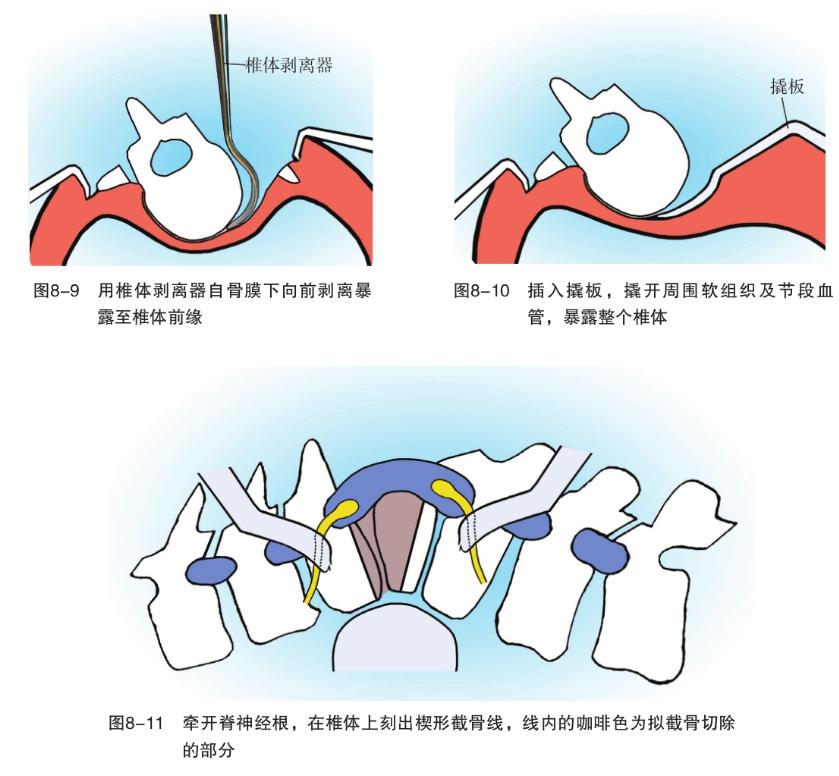 骨科基础：脊柱后侧凸截骨术