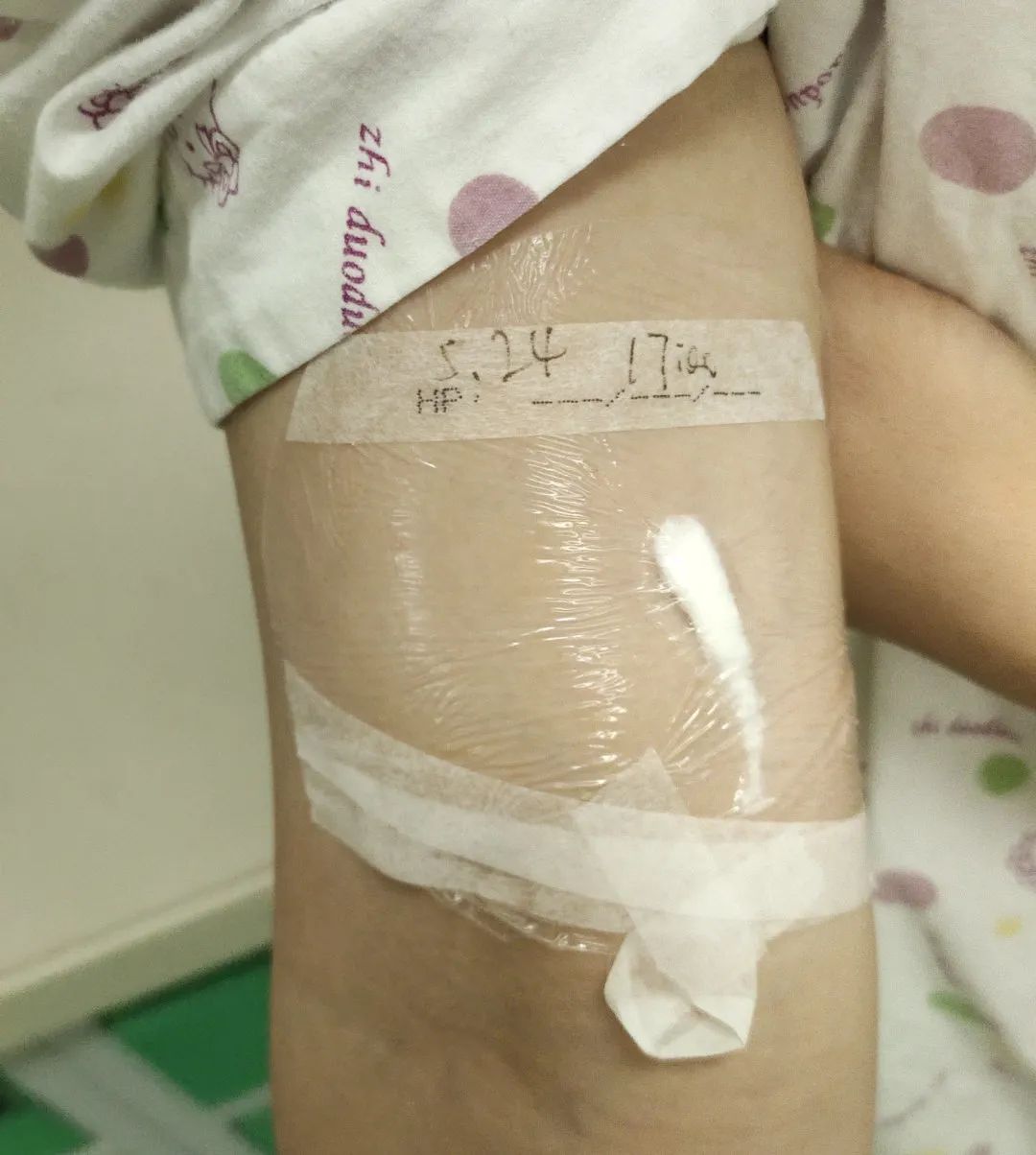 甲状腺做完手术多久能做乳腺手术,甲状腺手术后切气管