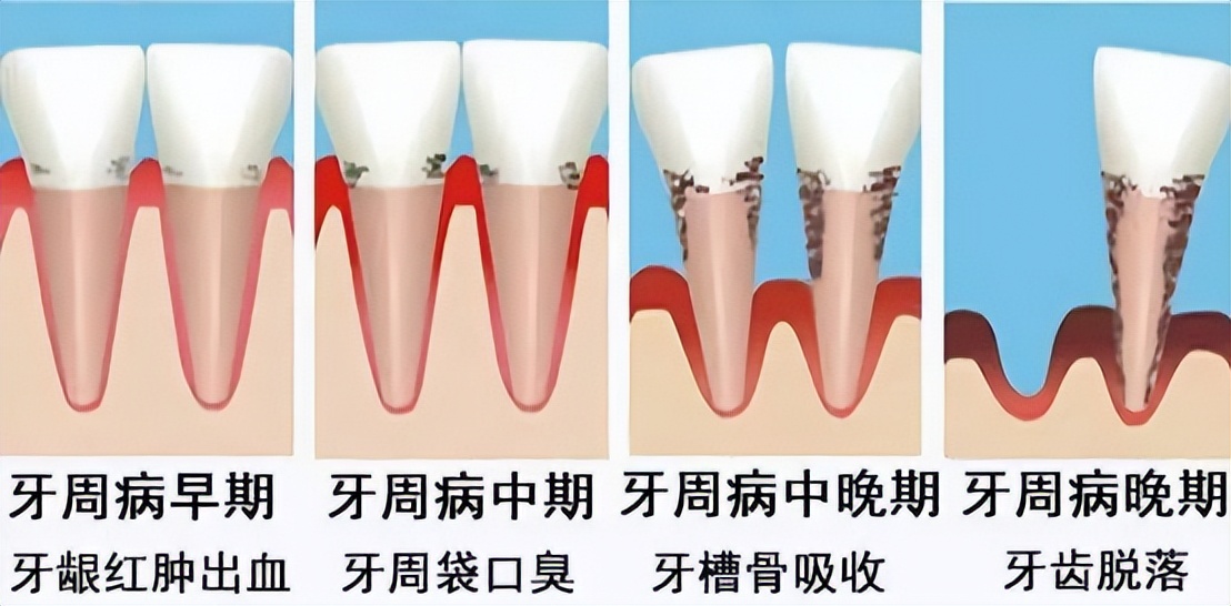 欧乐b电动牙刷对比飞利浦,欧乐b和飞利浦电动牙刷评测