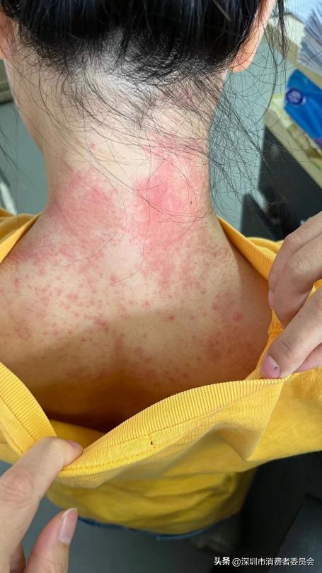 天天315|锁美护肤造型：消费者质疑产品致颈部过敏,申请退费却遭拒