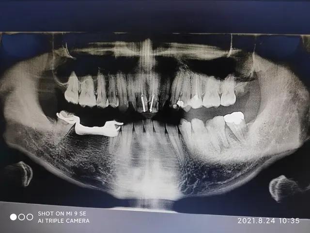 小男孩得了蛀牙必须拔牙,爸爸用电钻给儿子钻蛀牙后续