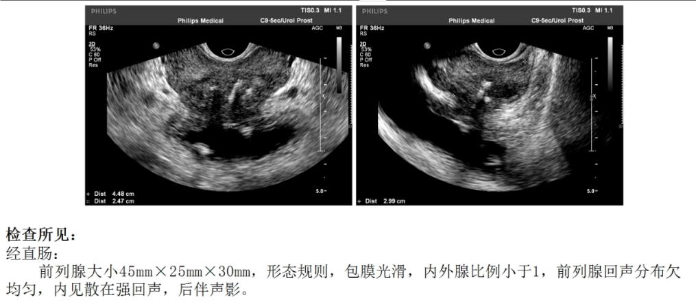 老人患膀胱癌如何减轻痛苦,68岁大爷做手术疼痛