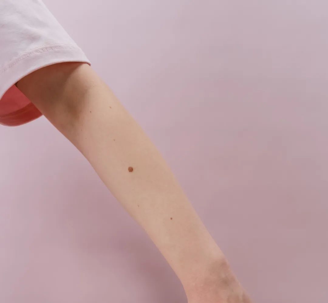 甲母痣癌变几率多大,多大的痣会癌变