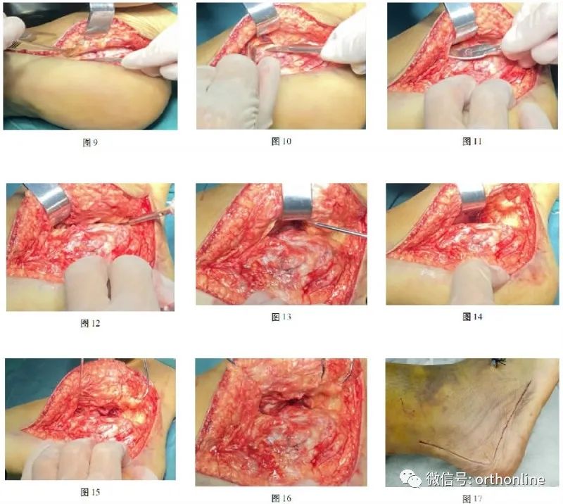 跟骨术后l型切口多久愈合,跟骨截骨矫正手法