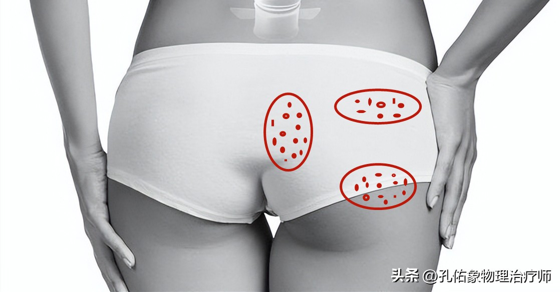 屁股疼是腰突导致的吗,屁股酸痛什么预兆