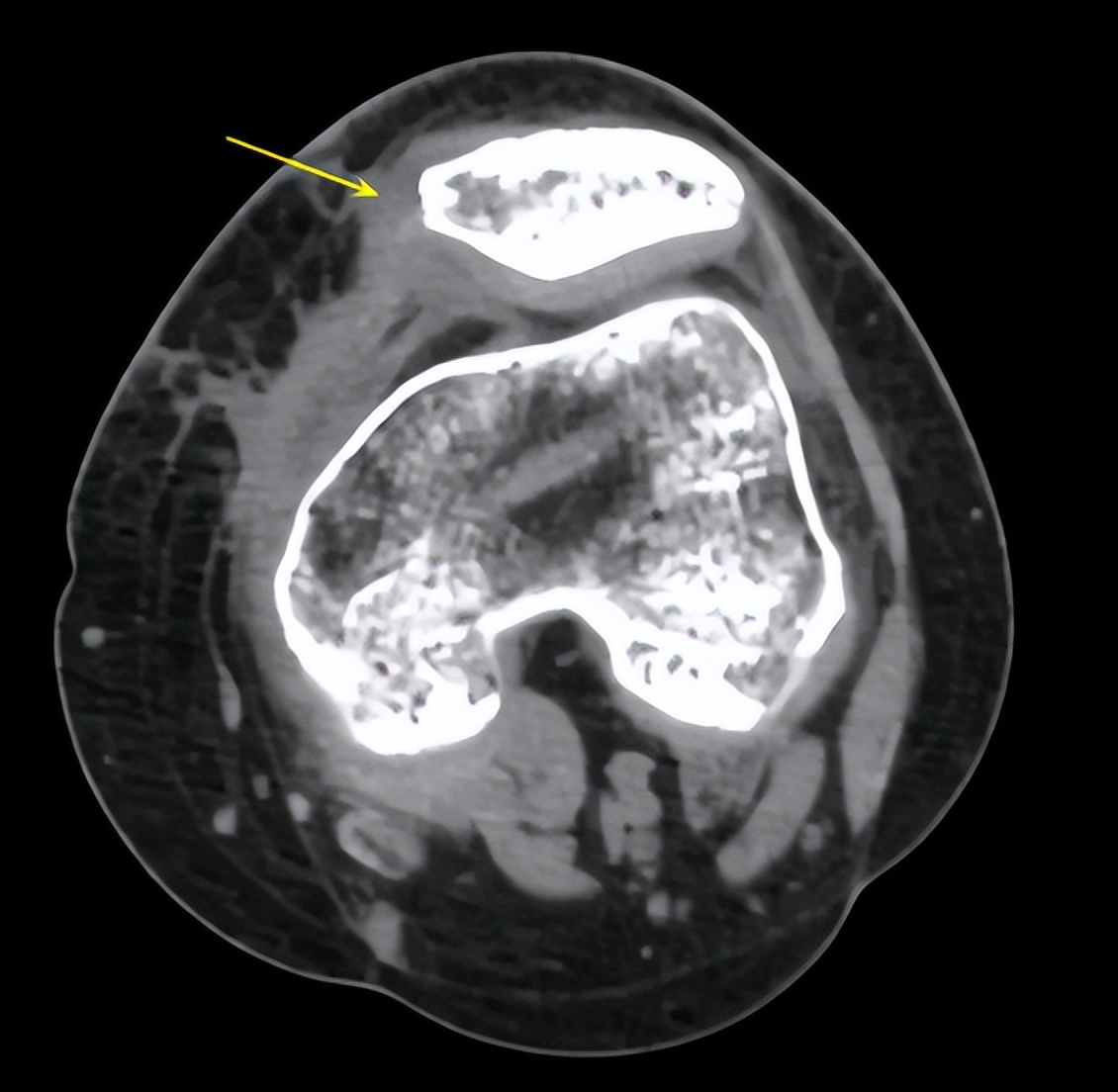 打羽毛球怎么防止肌腱断裂,打羽毛球韧带断裂
